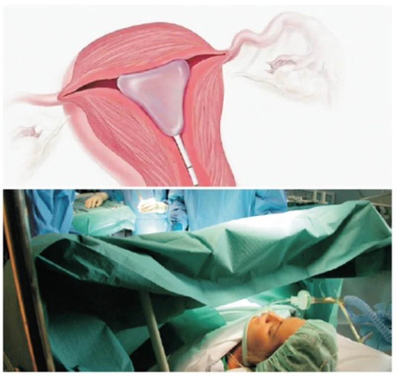 WD STENT WD STENT